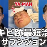 【ニキビ跡治療】サブシジョンをやったら効果ありすぎた