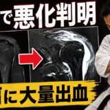 【四十肩？】劇的悪化…”MRIに映った大量出血”左肩に異変!?