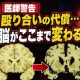 【殴り合いの代償】一度壊れたら戻らない脳「パンチドランカー」の恐怖
